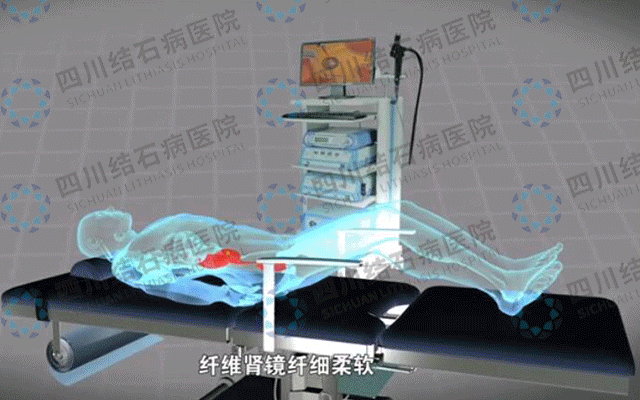 不开刀，不手术，一次性根治肾结石(图2)