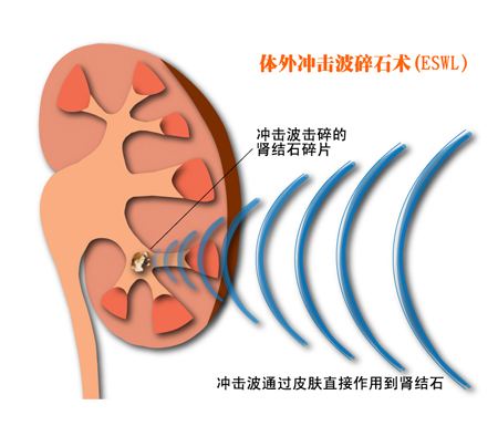 肾结石的检查方法有哪些？(图2)