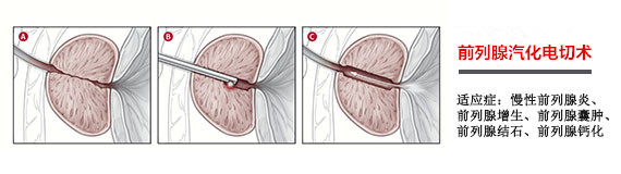 治前列腺增生，四川结石病医院更专业(图5)