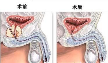 患者疑问：怎么治疗前列腺增生？(图6)