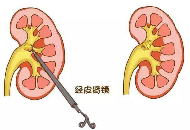 有肾结石要处理吗？多大需要手术？(图5)