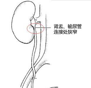 肾积水的形成原因是什么？(图2)