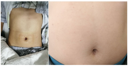 胆结石的极佳疗法——经脐隐瘢痕保胆取石术(图8)