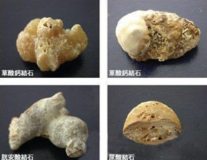 【检查】结石成分分析-杜绝结石病复发(图2)