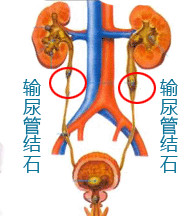 输尿管结石产生的原因是什么(图1)