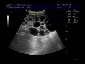 充满性胆结石(图1)