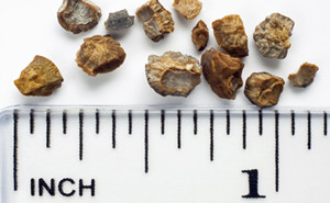 胆结石多大需要动手术？(图1)