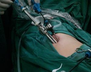 治疗胆囊息肉一定要摘除胆吗？(图2)