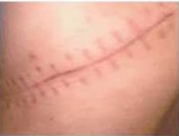 怎么治疗肾结石(图2)