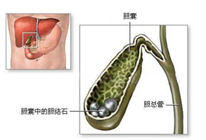 了解什么是胆囊结石呢？(图1)