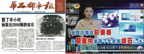 保胆取石手术成熟吗(图8)