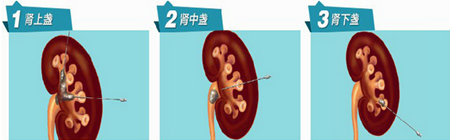 肾结石体外碎石危害(图2)