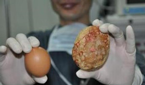 治疗胆结石真的只能切胆吗？(图1)