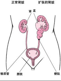 肾结石的并发症有哪些?(图1)