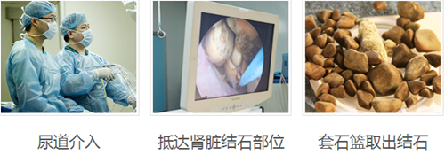 关于肾结石不得不知道的几件事(图5)