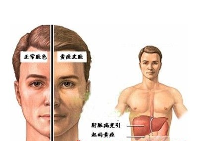 胆结石的症状及治疗方法？(图1)