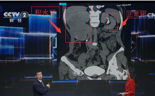 怎样轻松有效治疗结石引起的肾积水？(图1)