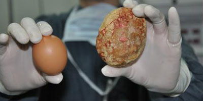 膀胱结石症状，竟带来这么多难言之隐......(图2)