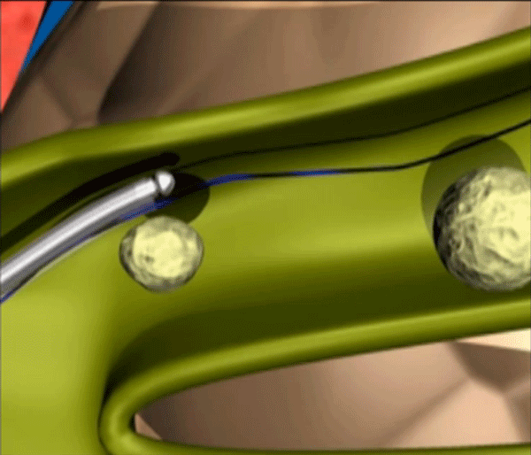 治疗胆结石选择医保定点医院——省钱，放心！(图3)