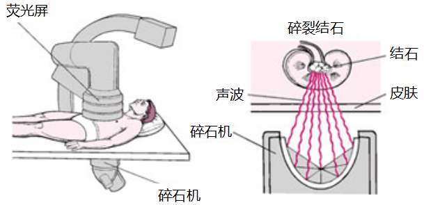 输尿管结石出现血尿，该怎么办？(图2)