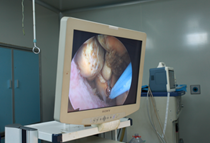 胆结石的极佳疗法——经脐隐瘢痕保胆取石术(图6)