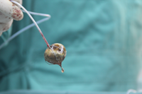 胆结石的极佳疗法——经脐隐瘢痕保胆取石术(图7)