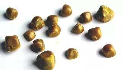 胆结石,一定非要切除胆囊吗?NO!(图1) 胆结石,一定非要切除胆囊吗?NO!(图1)