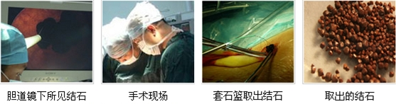 胆结石,一定非要切除胆囊吗?NO!(图5) 胆结石,一定非要切除胆囊吗?NO!(图5)