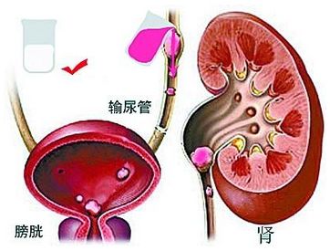 肾积水——来自肾脏的“高级别危险警报”(图5)