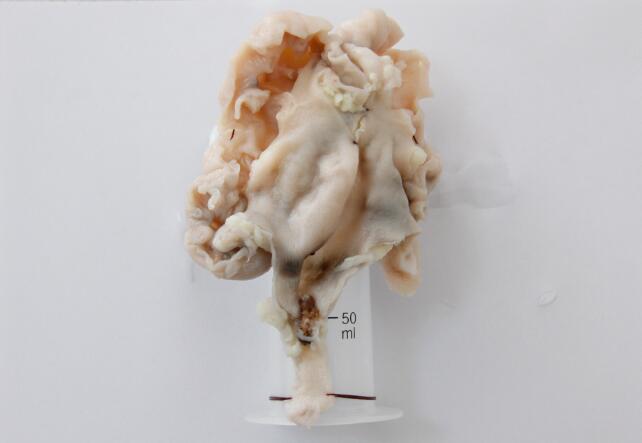 肾积水——来自肾脏的“高级别危险警报”(图4)