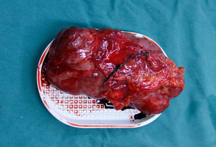 肾积水——来自肾脏的“高级别危险警报”(图3)