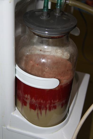 肾积水——来自肾脏的“高级别危险警报”(图2)