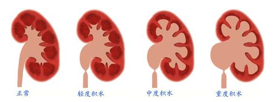 肾积水——来自肾脏的“高级别危险警报”(图1)